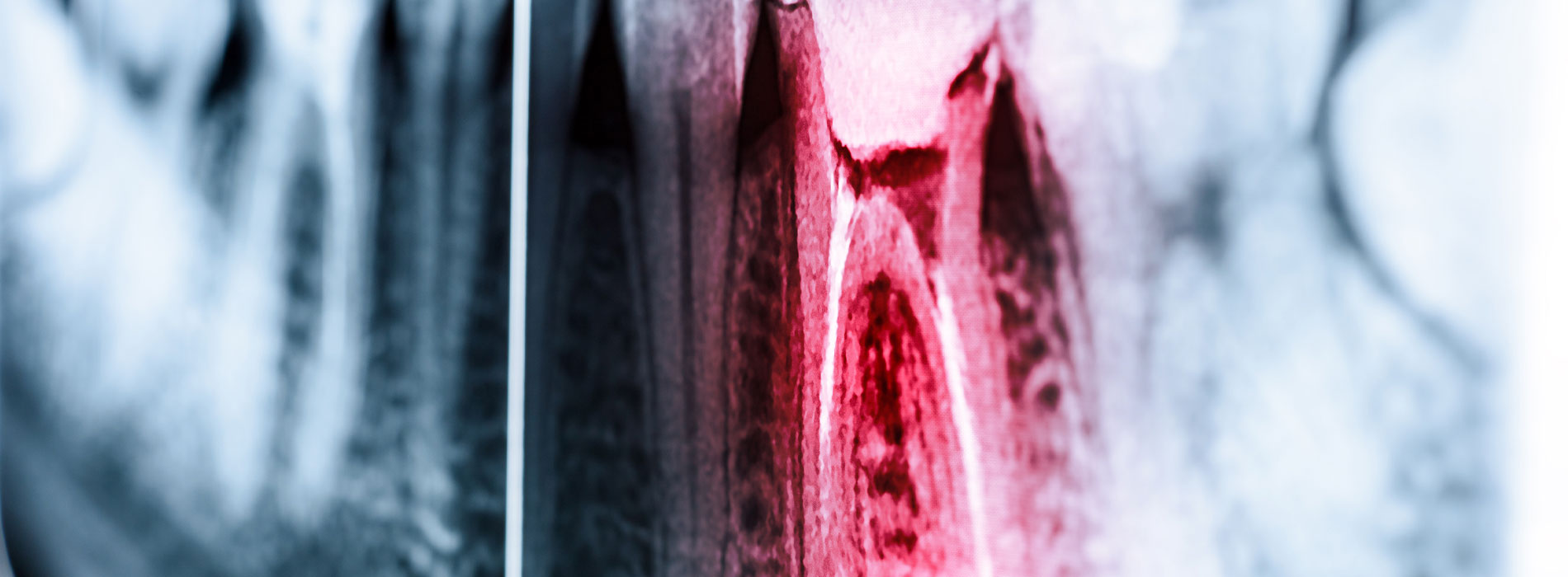 Apicoectomy in Abilene